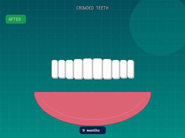 After — Severely Crowded Teeth