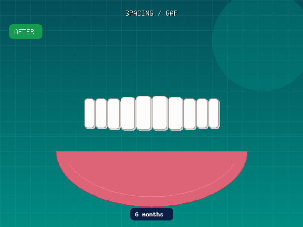 After — Diastema (Midline Gap)