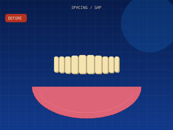 Before — Diastema (Midline Gap)