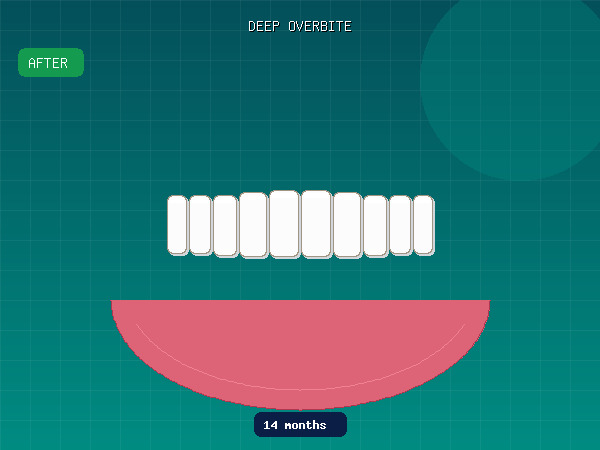 After — Deep Overbite