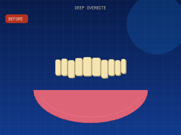 Before — Deep Overbite