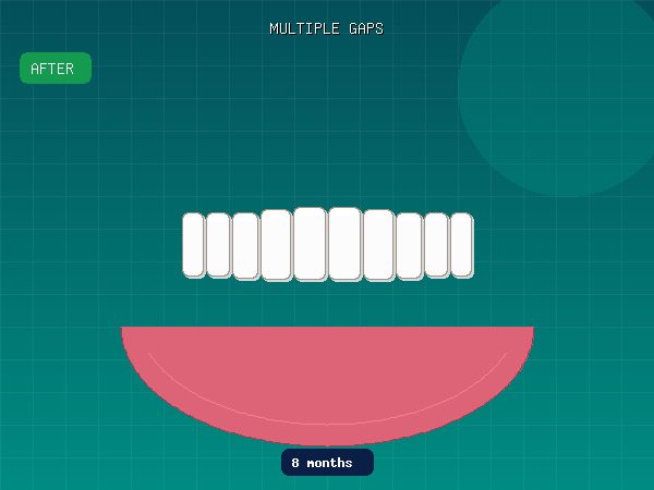 After — Multiple Gaps & Mild Crowding